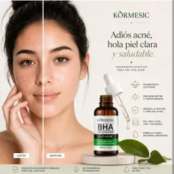 Sérum Anti Acné BHA