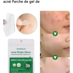 Parches para el acné.