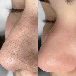 Limpieza Facial Profunda