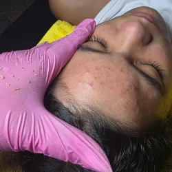Limpieza facial Profunda