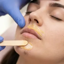 Depilación de Mentón