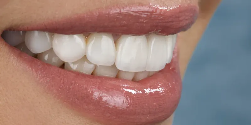 Carillas dentales 