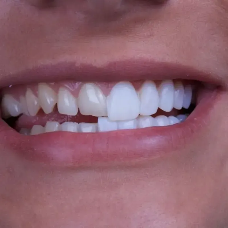 Carillas dentales 