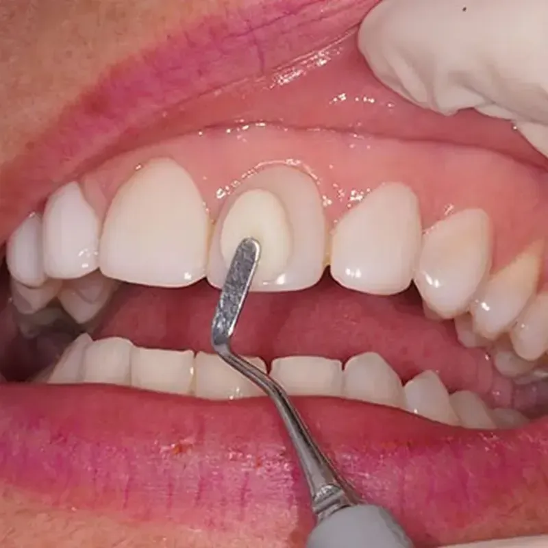 Carillas dentales 