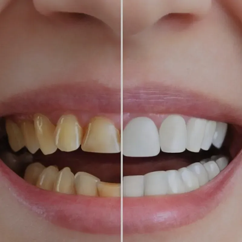Carillas dentales 