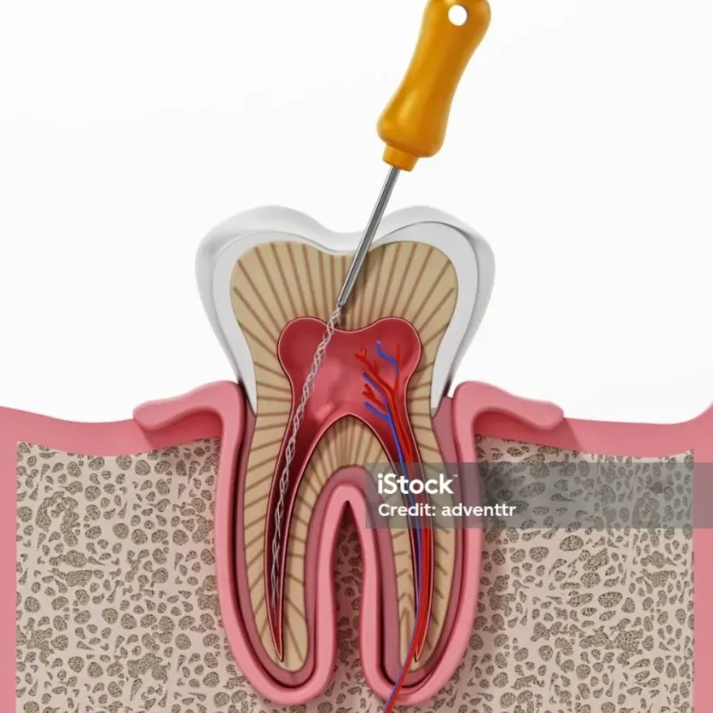 Endodoncia en diente anterior