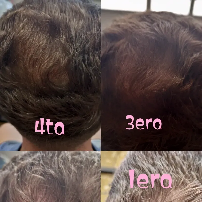 Tratamiento de regeneración capilar 