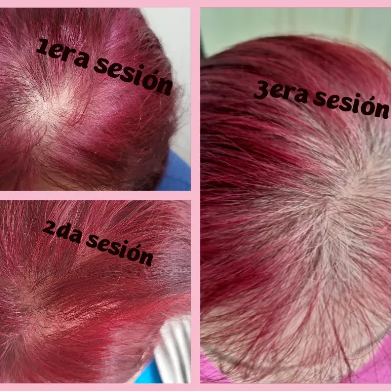 Tratamiento de regeneración capilar 