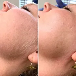 Waxing|Rostro femenino completo 