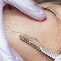 Dermaplaning