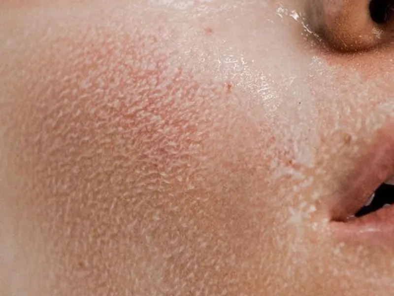 Piel Seca, Deshidratada y Sensible