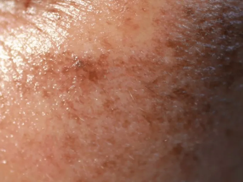 Hiperpigmentación y Manchas