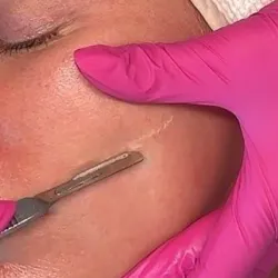 Dermaplaning