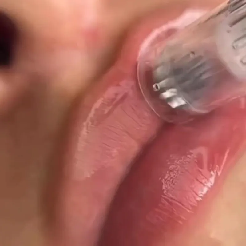 Hidralips( Microneedling de labios)