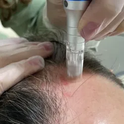 Microneedling capilar