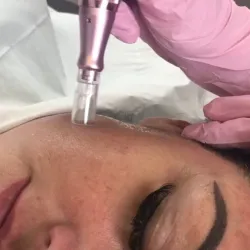 Microneedling facial