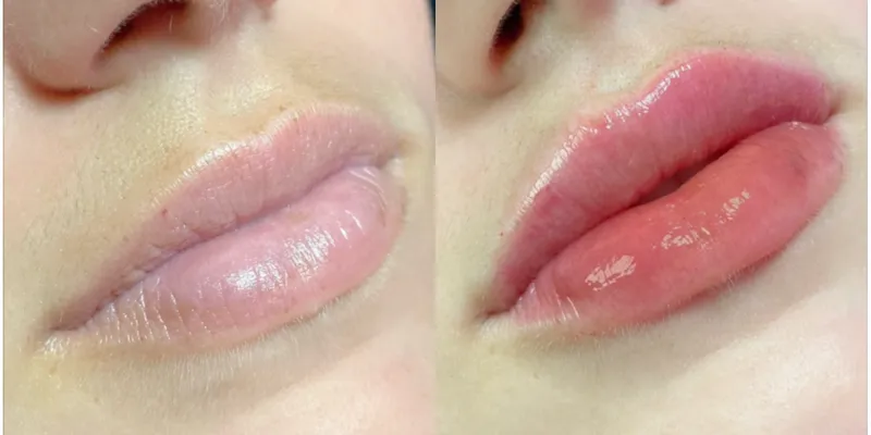 Labios con Ácido Hialurónico 