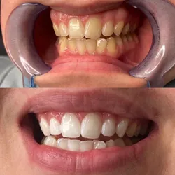 Limpieza Bucodental+Blanqueamiento dental+Laserterapia Gingival