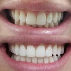 Limpieza Bucodental + Blanqueamiento dental 