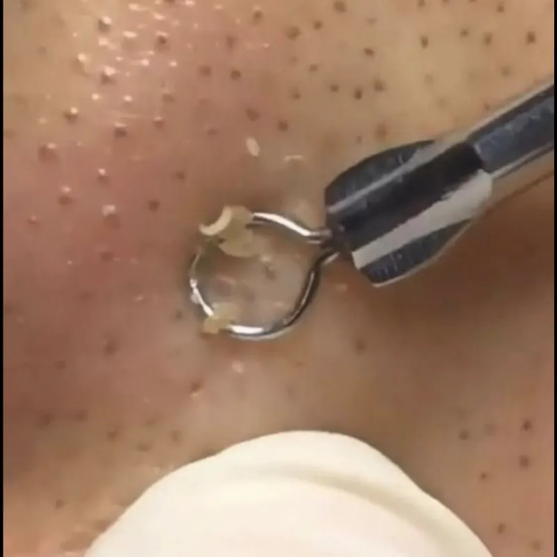 Limpieza Facial Profunda