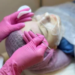 Peeling químico 