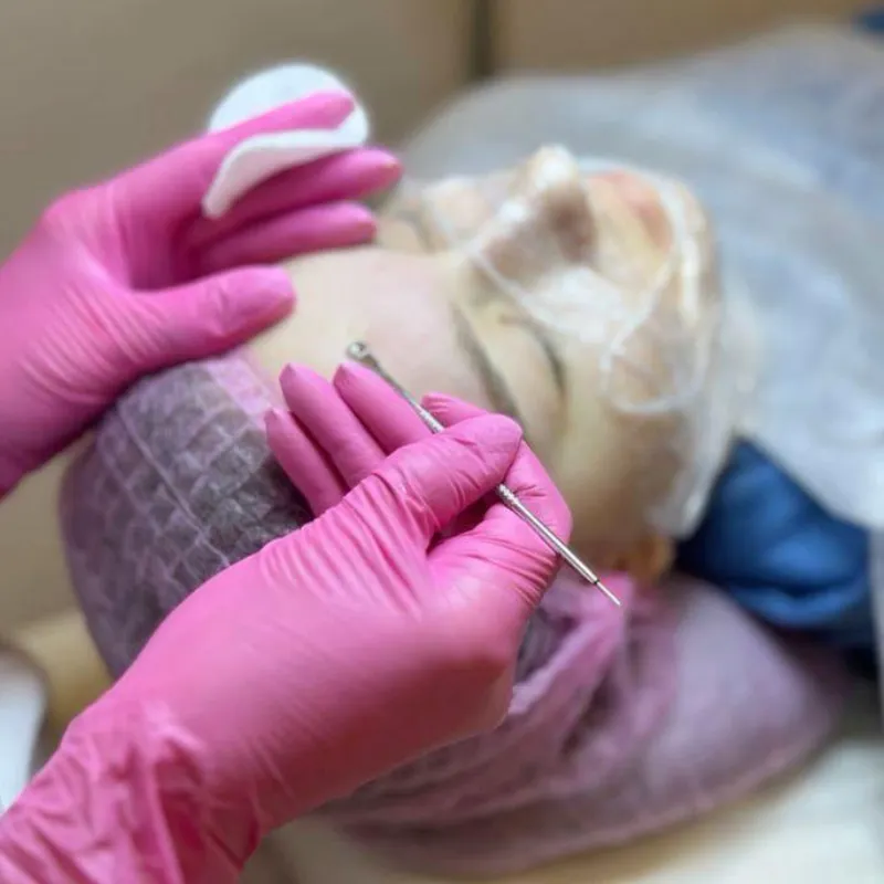 Peeling químico 
