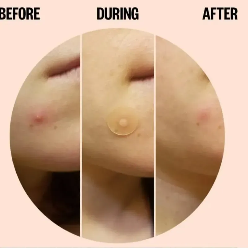 Parches de Ácido Salicílico para el Acné