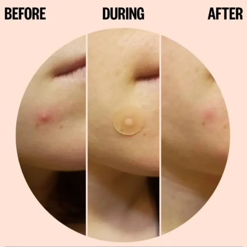 Parche para el Acné