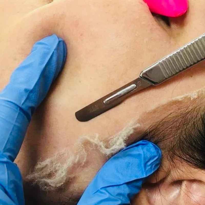 Dermaplaning