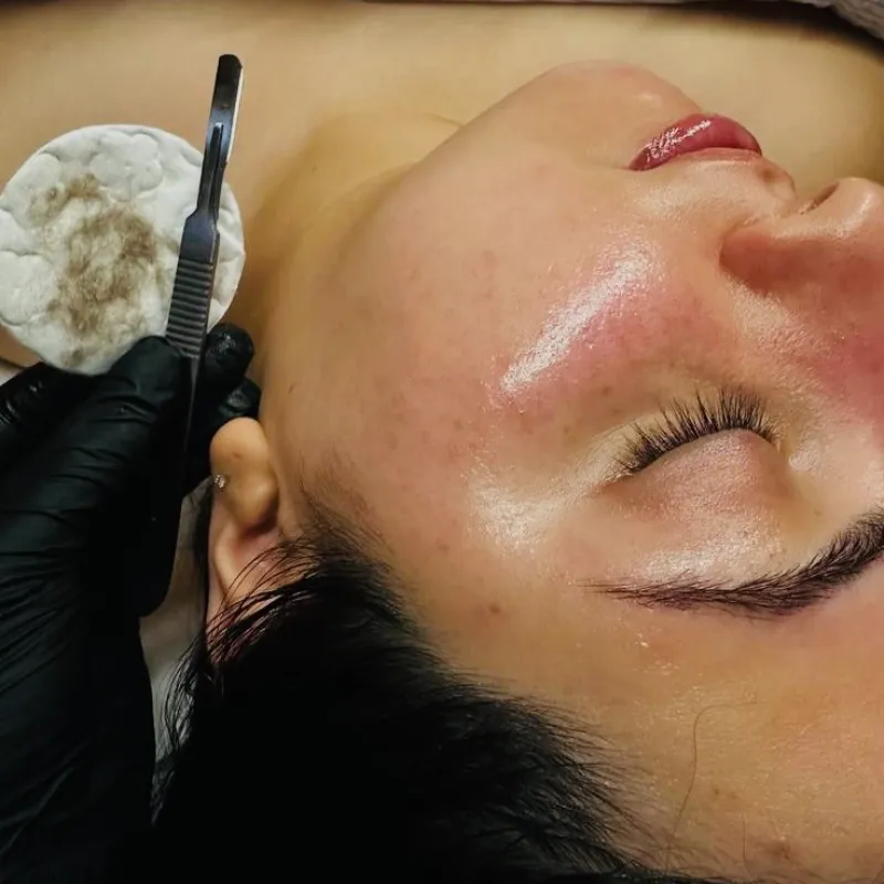 Dermaplaning