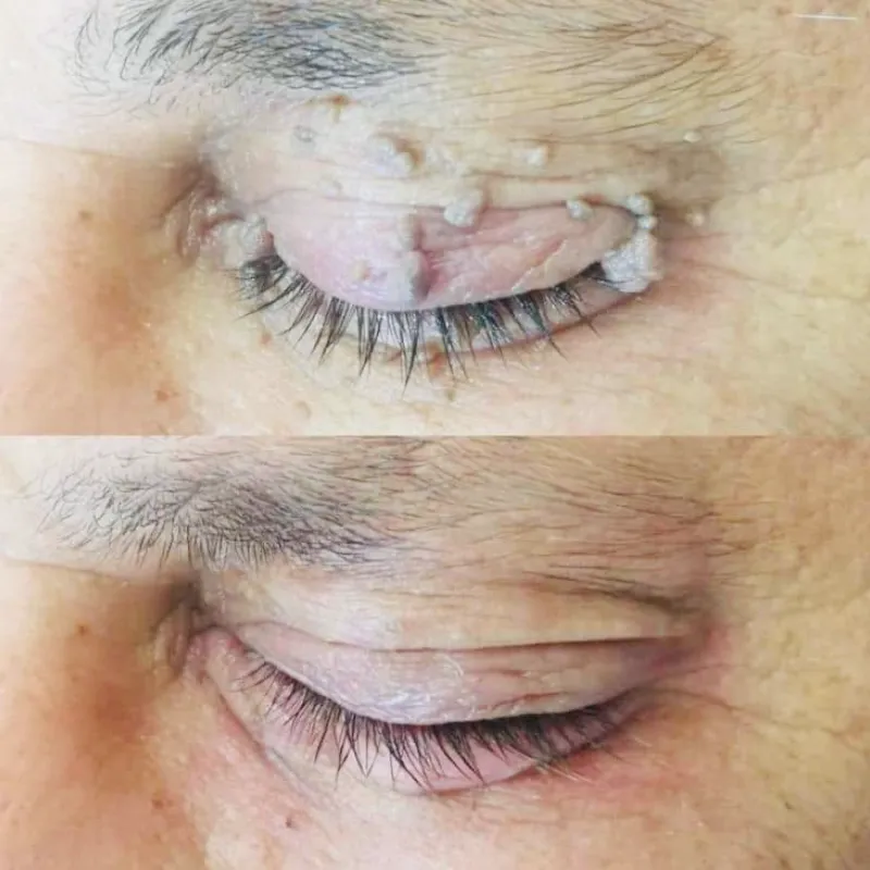 Eliminación de verrugas con fibroblast