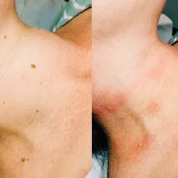 Eliminación de verrugas con fibroblast