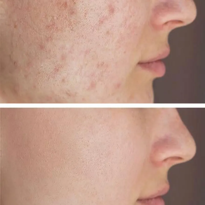 Facial antiacné
