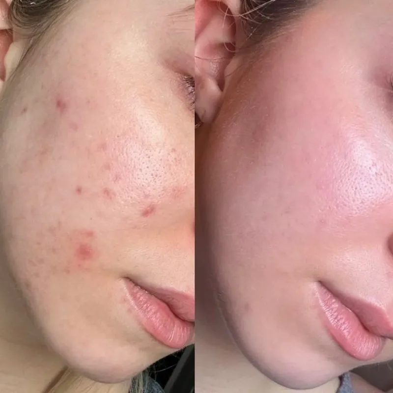 Facial antiacné