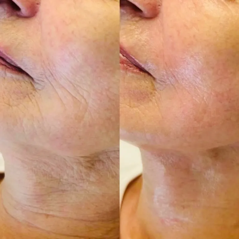 Facial Antienvejecimiento