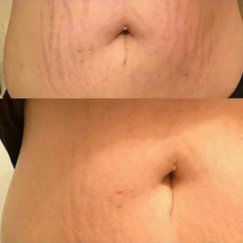 Fibroblast para estrías