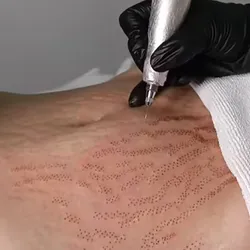 Fibroblast para estrías