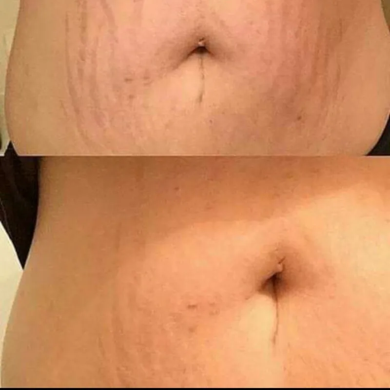 Fibroblast para estrías