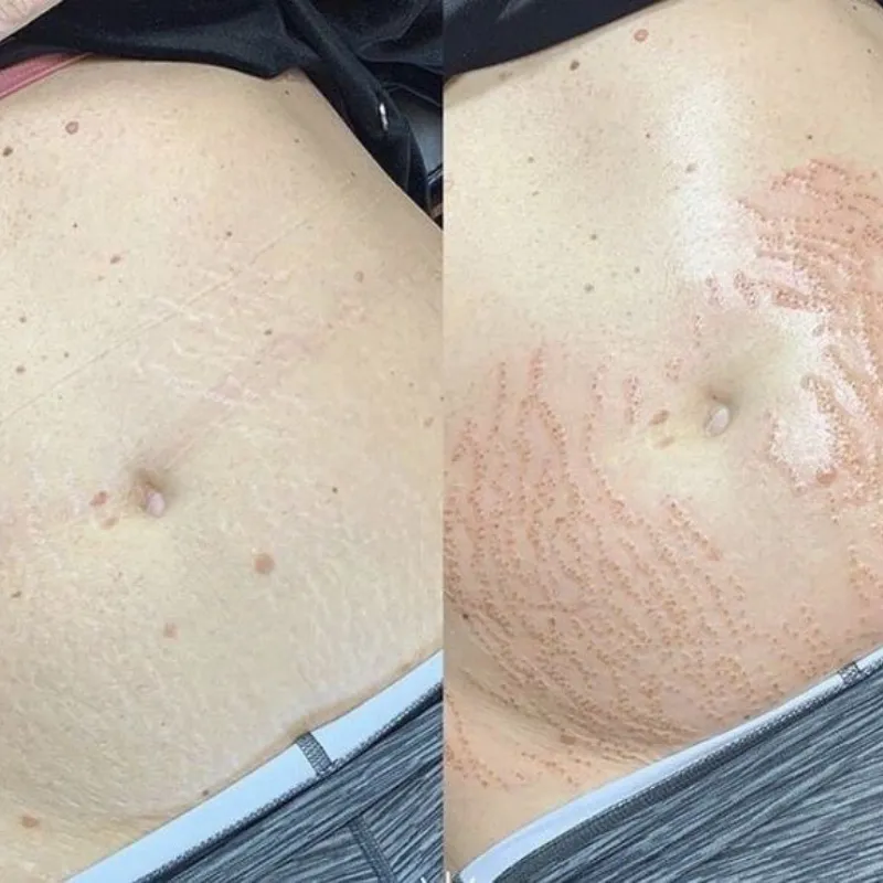 Fibroblast para estrías