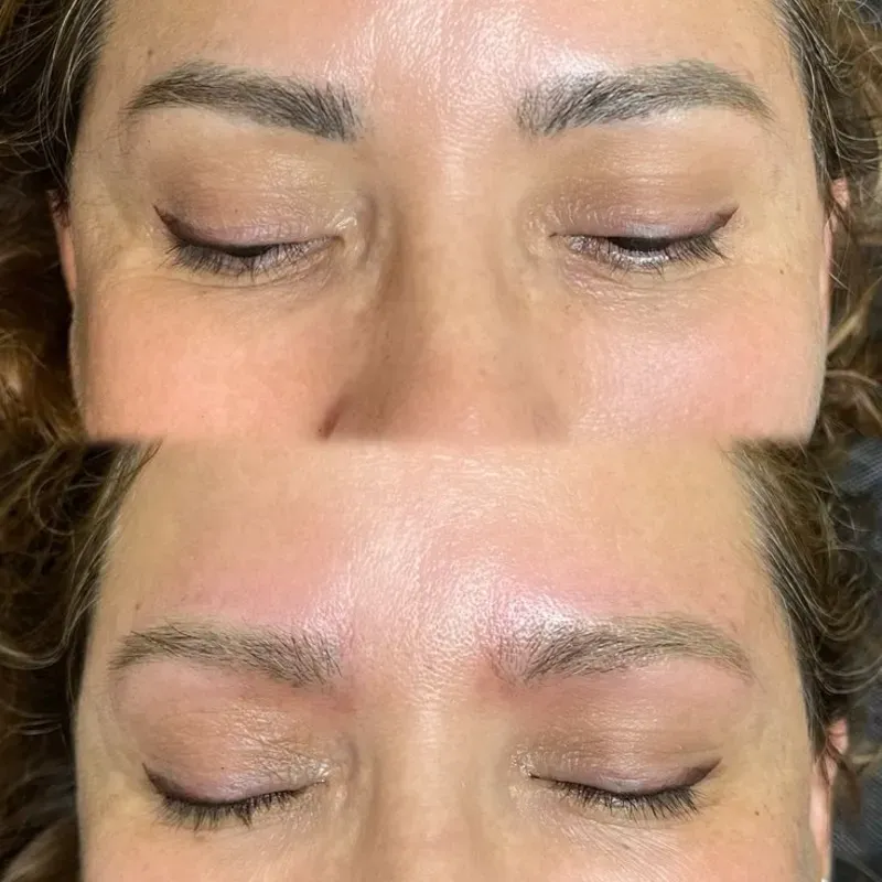 Láser para eliminación de cejas