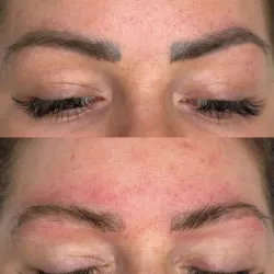 Láser para eliminación de cejas