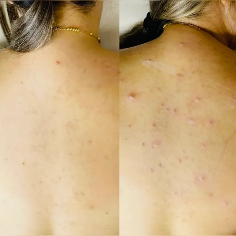 Limpieza profunda de espalda