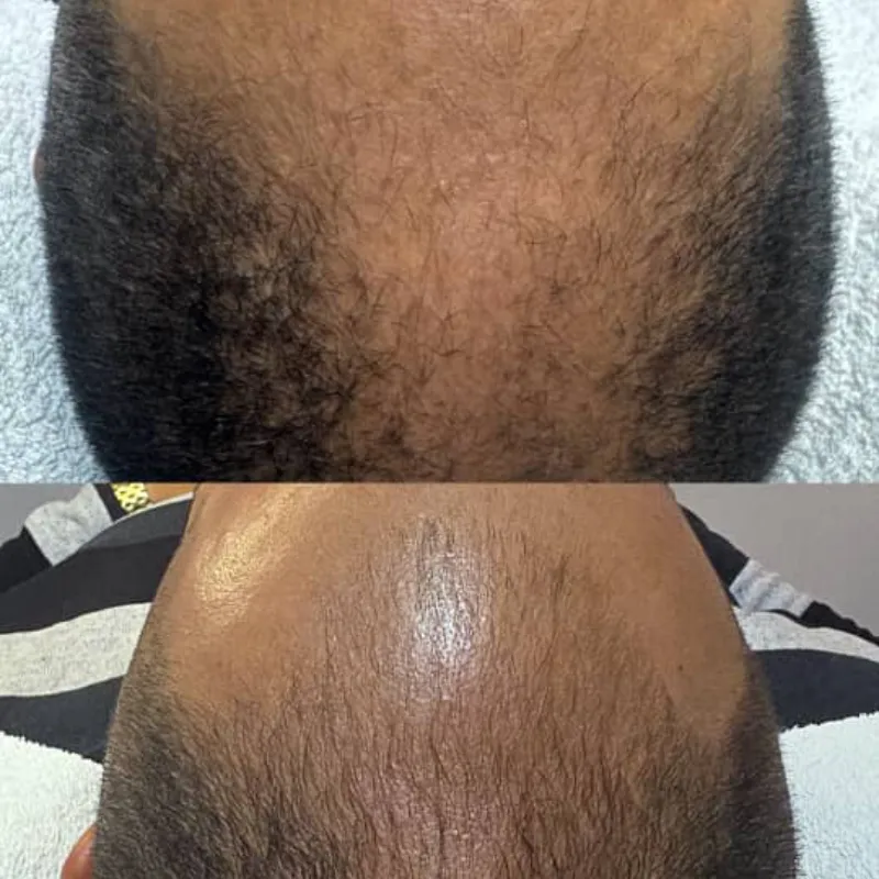 Microneedling capilar