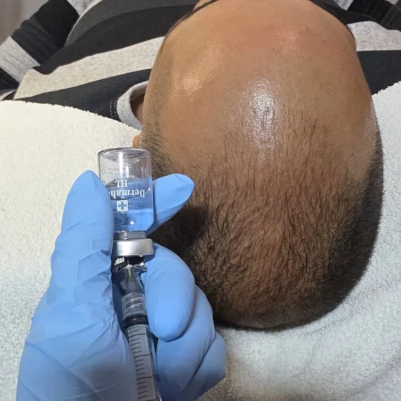 Microneedling capilar