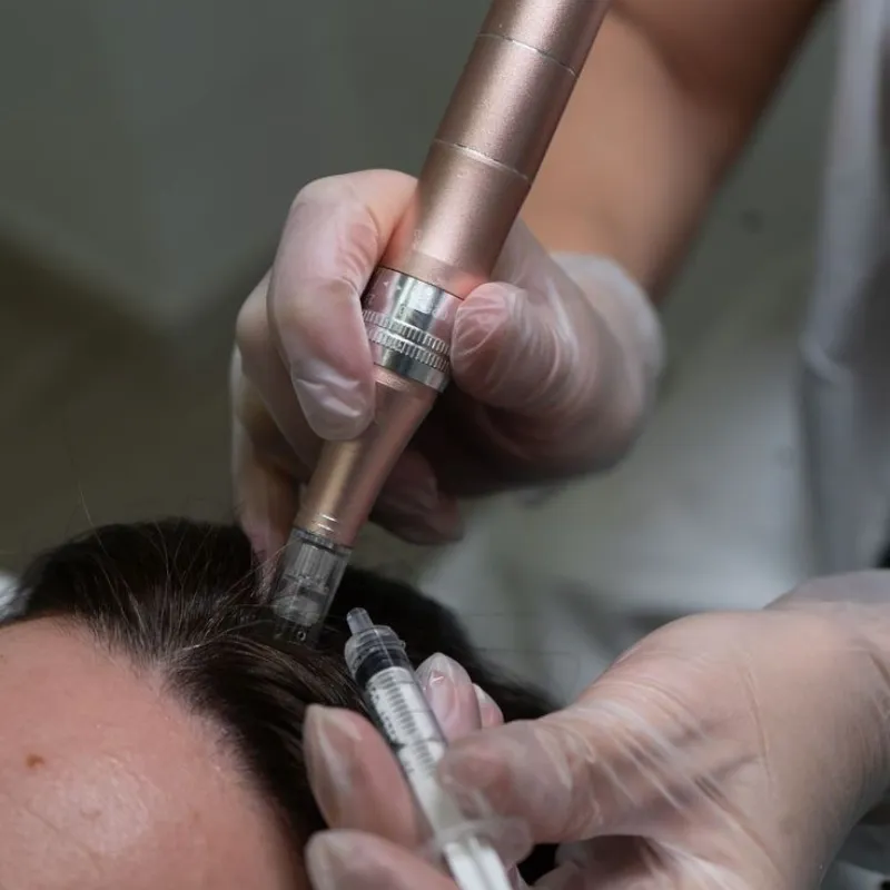 Microneedling capilar