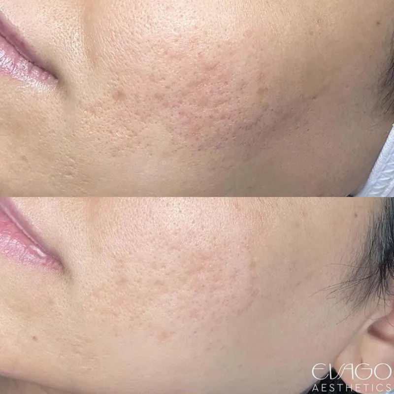 Microneedling Facial con Dermapen