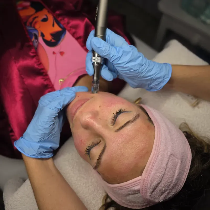 Microneedling Facial con Dermapen