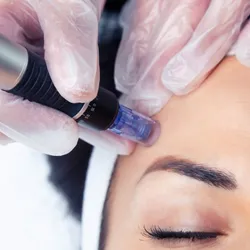 Microneedling Facial con Dermapen