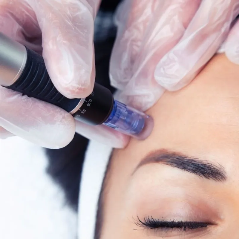 Microneedling Facial con Dermapen