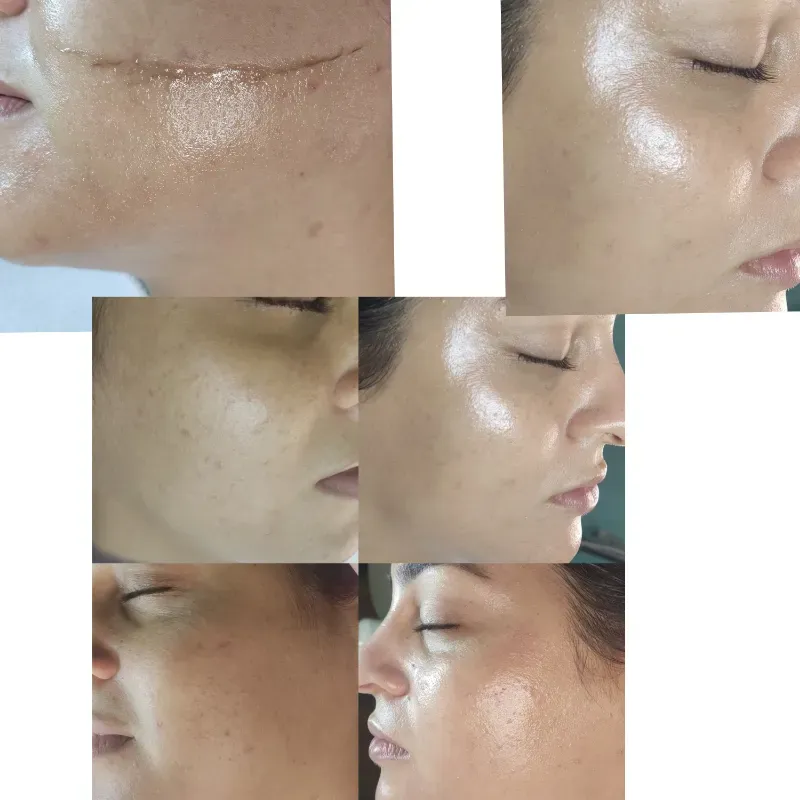 Bb glow + dermaplanin